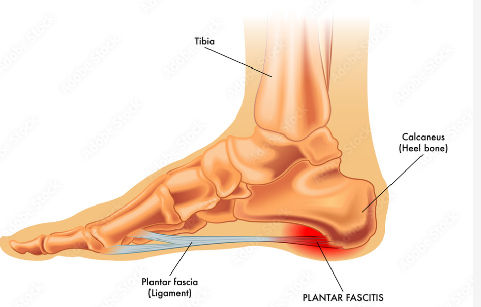 Fascite plantare